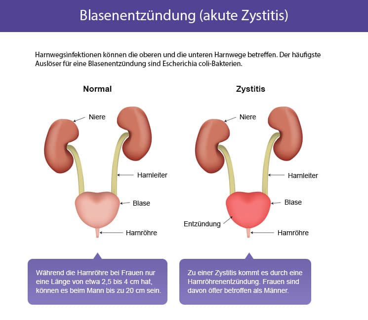 Blasenentzüdung